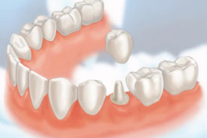 Graphic Image of Bottom Set of Teeth Showing a Crown