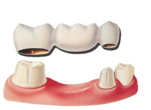 Graphic Image of an example of an Dental Bridge