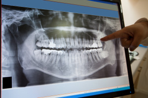 Photo of Dental X-Ray of a set of teeth being examined